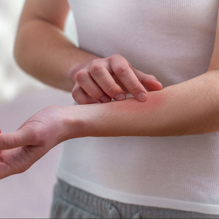 Young woman suffering from itching on her skin and scratching an