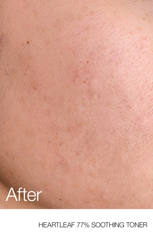 AnuaUS_HeartleafToner_862x1341_After_Listing_ceb3f5fd-5437-4c31-9fae-84f75cb1620d